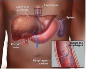 varices