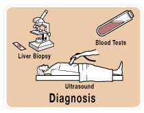 cirrhosis