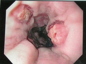 varices