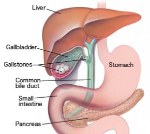gallstones