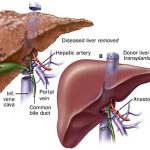 liver transplant