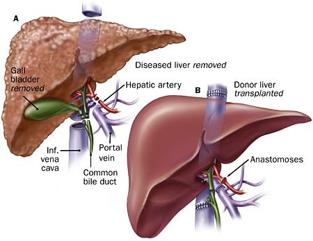 liver transplant