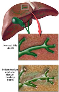 Primary sclerosing cholangitis