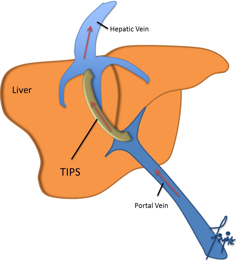 What Are the Treatments for Portal Hypertension? Livers