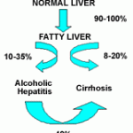 alcoholic hepatitis