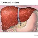 alcoholic liver disease