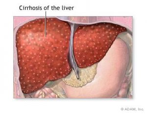 alcoholic liver disease