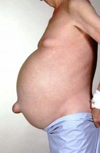 ascites