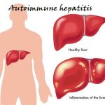 autoimmune hepatitis