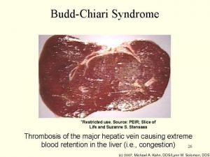 budd-chiari