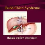 budd-chiari