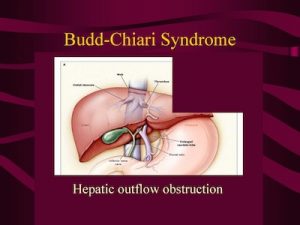 budd-chiari