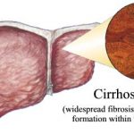 cirrhosis