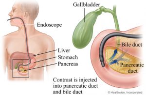 ercp