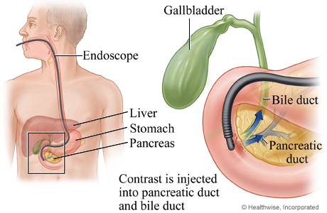 ercp