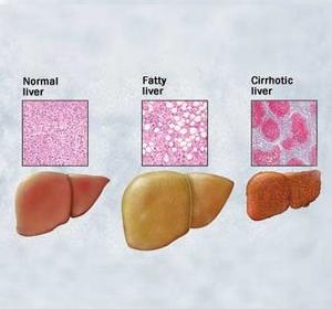 fatty liver