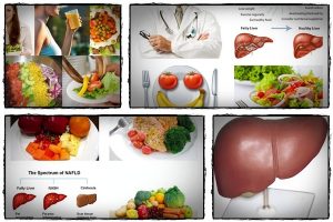 fatty liver diet