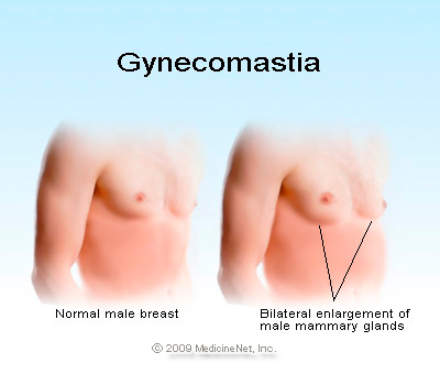 gyncomastia