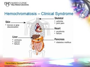 hemochromatosis