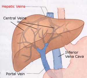 Hepatic Vein Thrombosis