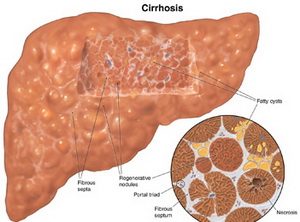 cirrhosis