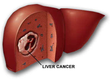 liver cancer