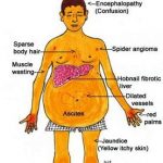 liver cirrhosis