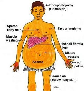 Cirrhosis of the Liver Stage 4 | Livers With Life