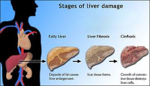 liver fibrosis