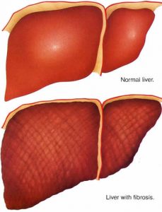 liver fibrosis