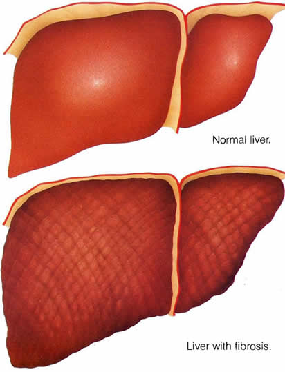 liver fibrosis