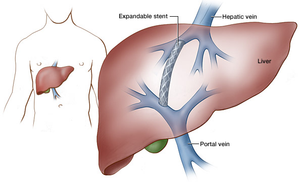 liver stent