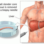 liver biopsy