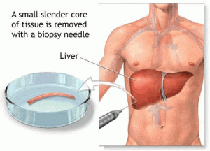 liver biopsy