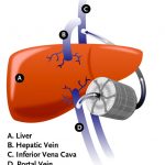 liver implant