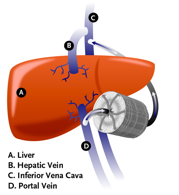 liver implant