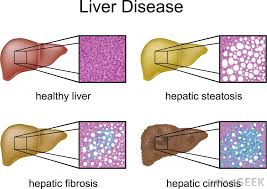 liver disease