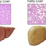 fatty liver