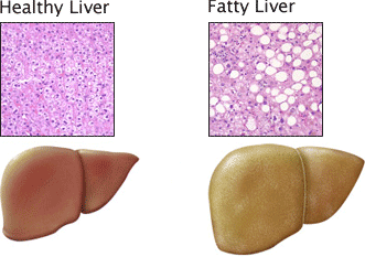 fatty liver