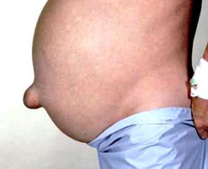 umbilical hernia