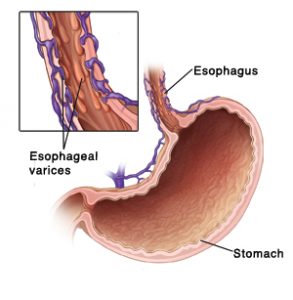 varices