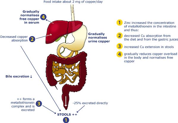 wilsons disease