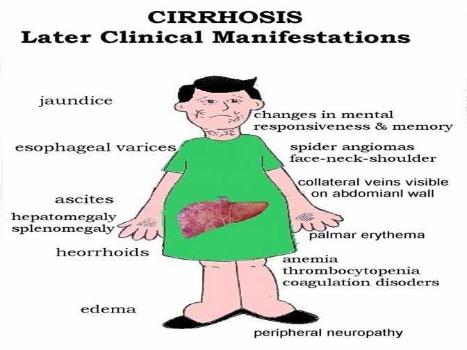 cirrhosis complications