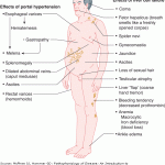 cirrhosis