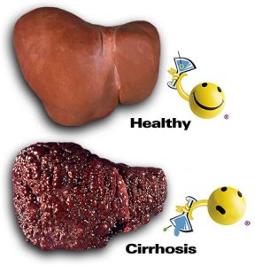 cirrhosis