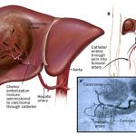hepatocellular carcinoma