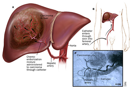 hepatocellular carcinoma