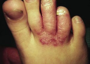pruritus