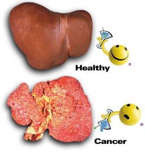 liver cancer
