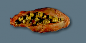 gallstones